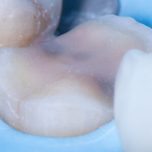 Overlay, Onlay, & Advanced Adhesion Hands On Course - February 2nd-3rd