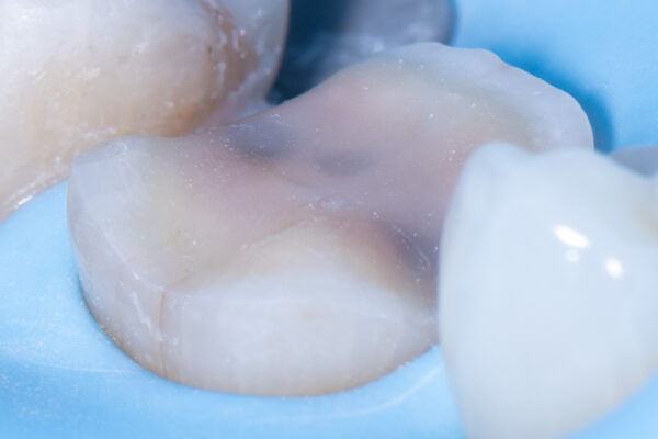 Los Angeles - LECTURE & HANDS ON WORKSHOP - Overlay, Onlay, & Advanced Adhesion Nov 1st