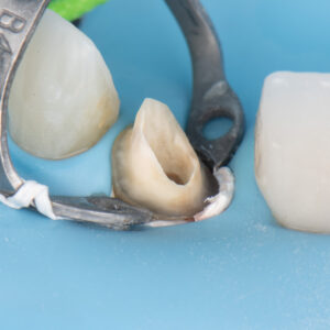 Advanced Adhesive Solutions for Highly Compromised Teeth January 24th-25th
